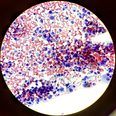 Metastatic squamous cell carcinoma