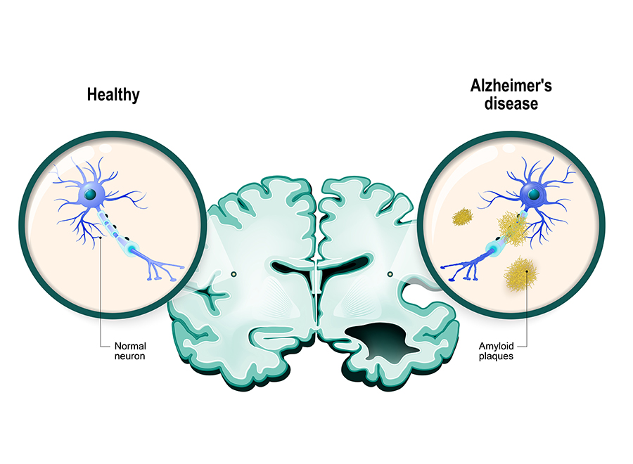 Illustration of a brain with Alzheimer's disease