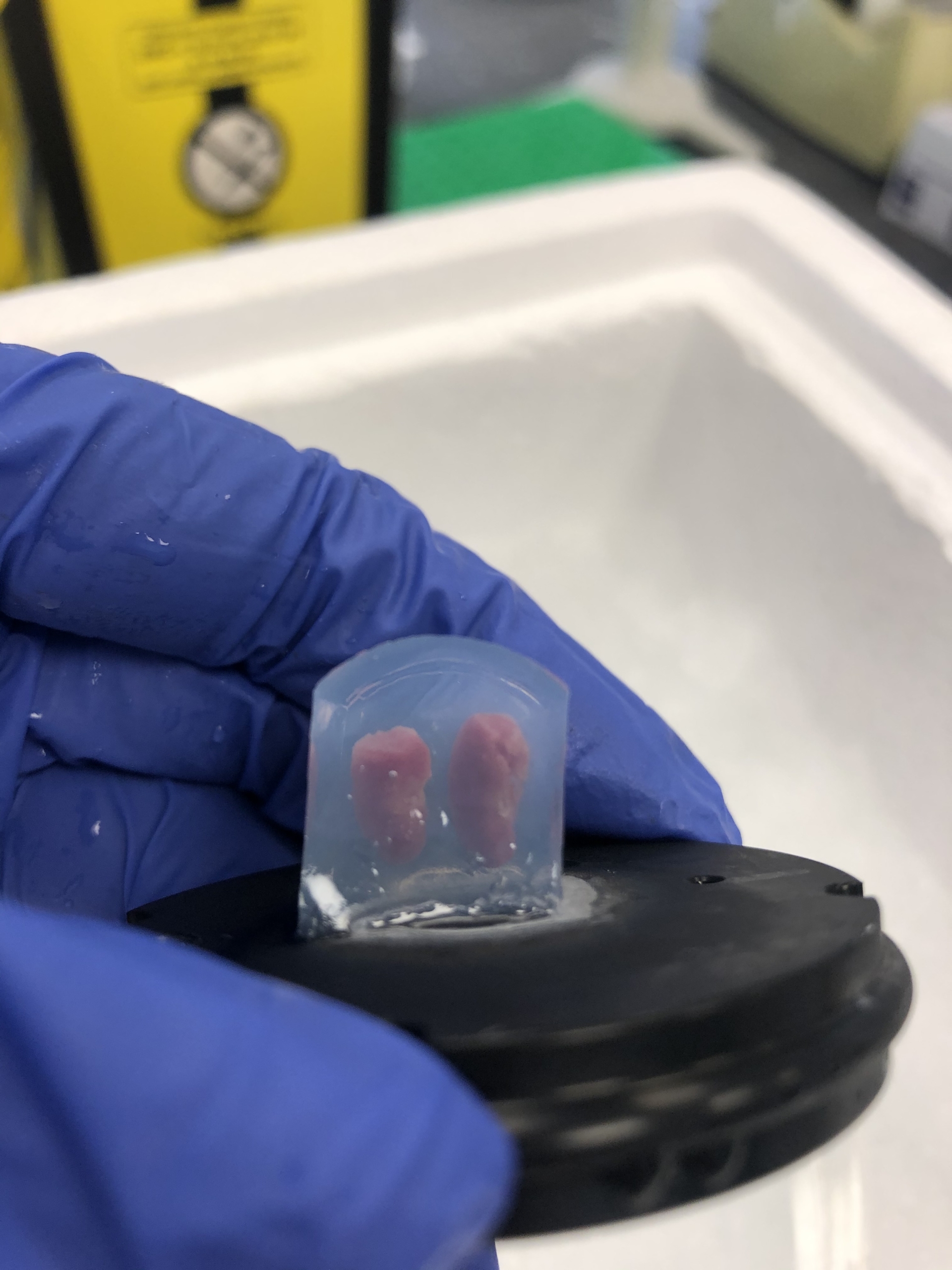 Precision Cut Kidney Slices (PCKS) in Chronic Kidney Disease (CKD) to Help Select Better Drug Candidates and Bridge the Translational Gap